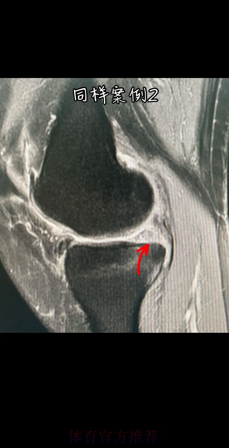 官方：阿拉巴左膝内侧半月板撕裂 预计伤缺6-8周